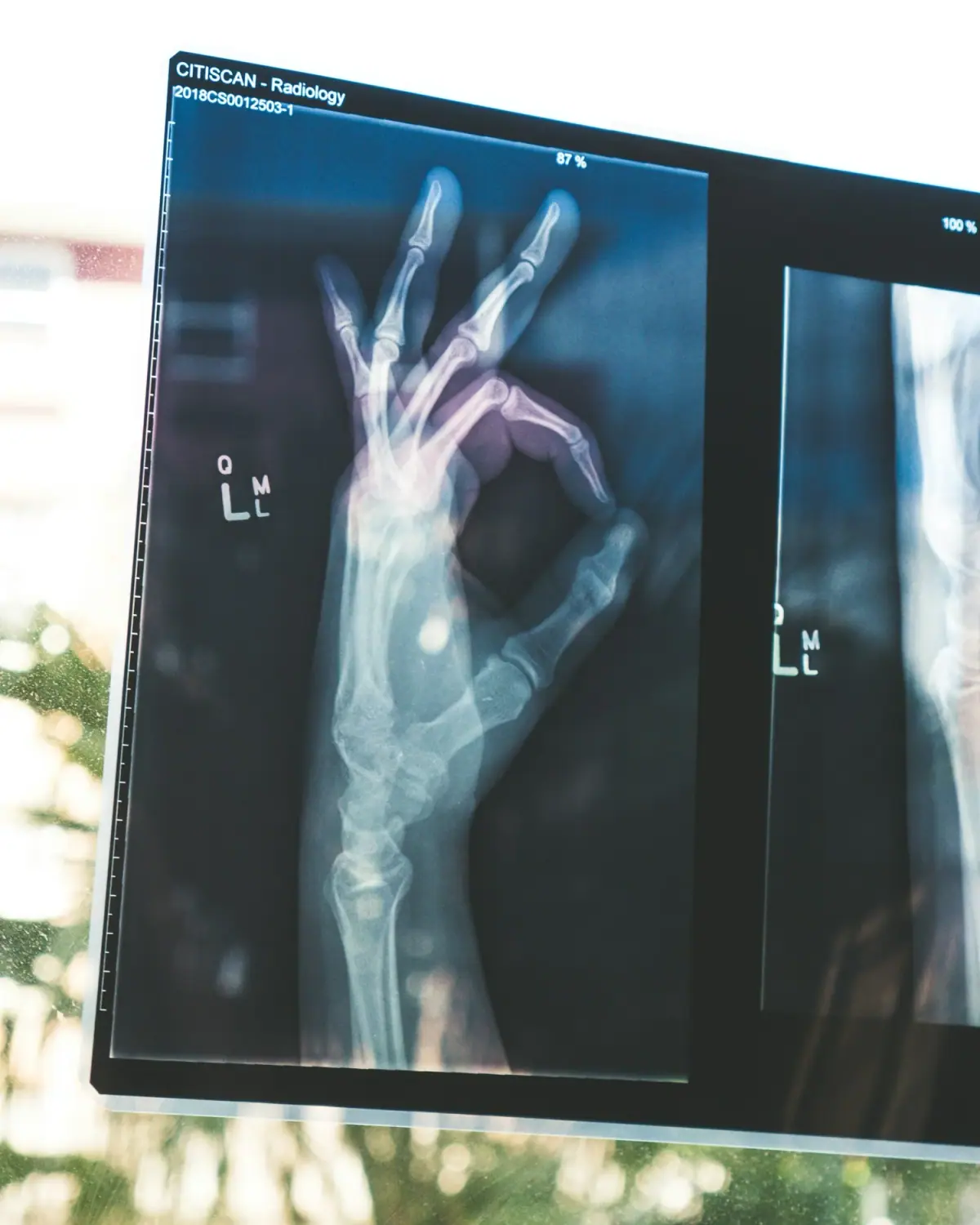 X-ray image of a human hand and wrist showing bones, with labels and a percentage at the top.
